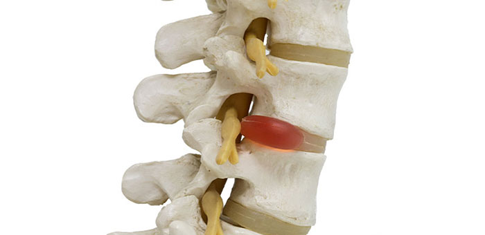 Herniated disc in spine before visiting Brentwood chiropractor