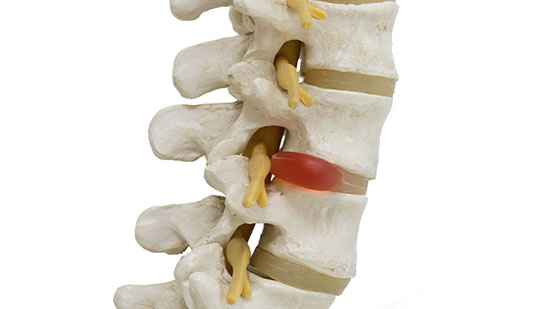 Herniated disc in spine before visiting Brentwood chiropractor