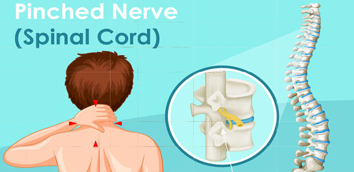 Pinched nerve in spine before chiropractic treatment from Brentwood chiropractor