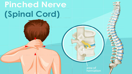 Pinched nerve in spine before chiropractic treatment from Brentwood chiropractor