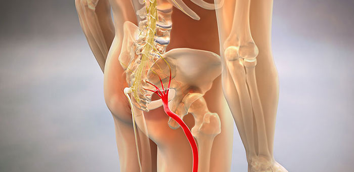 Sciatic nerve pain before chiropractic treatment from Brentwood chiropractor