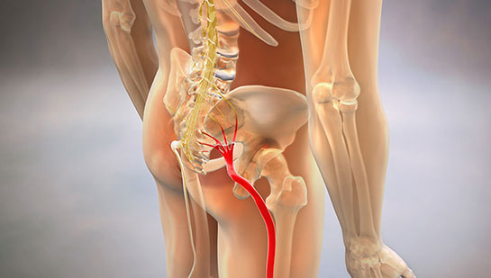 Sciatic nerve pain before chiropractic treatment from Brentwood chiropractor