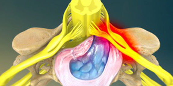 Herniated Disc Brentwood